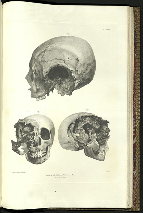 Hermann Lebert, Traite d'Anatomie Pathologique, 1857-1861